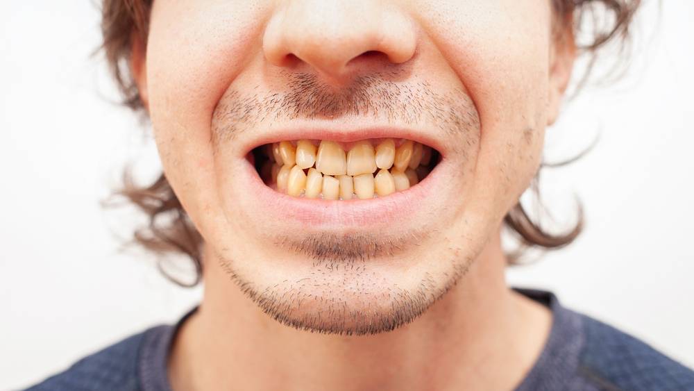 ¿Cómo eliminar las manchas en los dientes?
